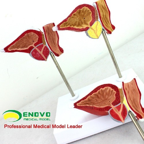 Modelo anatómico médico genitourinario normal y enferma glándula prostática - Imagen 11 de 12