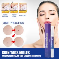 12 Hours Wart Remover Pen Skin Tag Eliminate Foot Corn Warts Unisex 3ml