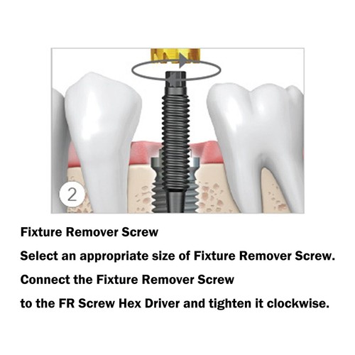 US DentalFixture Remover Kit rimozione impianto cacciavite Neobiotech chiave FR - Foto 4 di 18