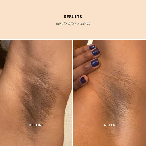 Dark Spot Exfoliating Scrub - Natural Body Scrub Exfoliant to Hydrated, Soften a - Picture 4 of 12