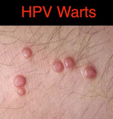 hpv genital verruca