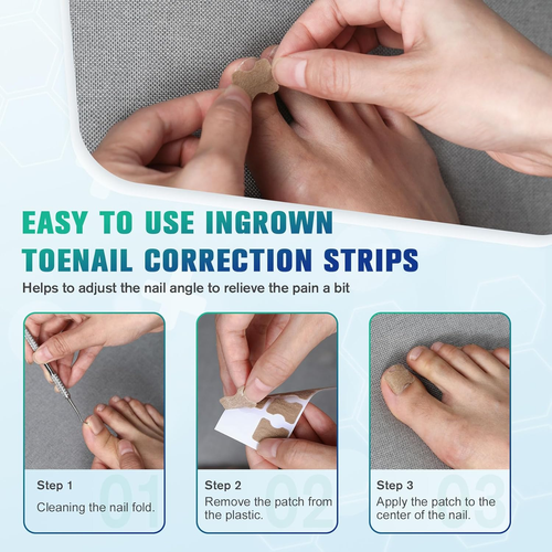 50 PCS Breathable Ingrown Toenail Corrector Patch with Double-Ended Stainless St - Picture 3 of 12