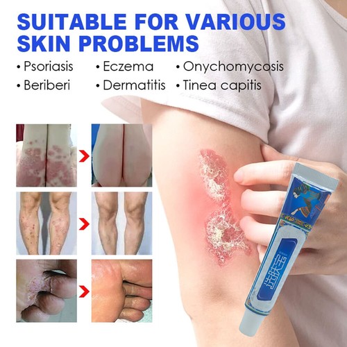 Body Skin Care Cream Anti-Itch Repair Skin Anti Fungal Ointment 15g - Picture 7 of 9