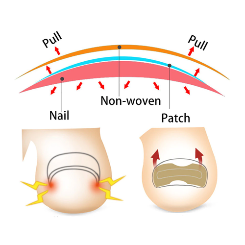 10/20/30/50Pcs Glue Free Toenail Toe Ingrown Nail Correction Patch Nail Sticker~ - Bild 10 von 14