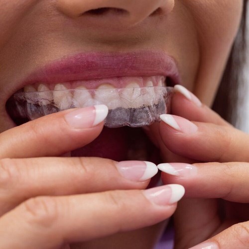 Bite Dentale Notturno Automodellante anti Bruxismo - Foto 7 di 9