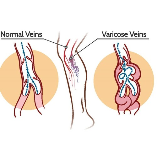 Tratamiento Para La Varices Ungüento Que Alivio Dolor Venas Y La Flebitis - Picture 3 of 6