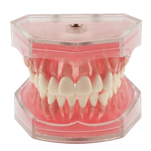 Dental Typodont Zahnmodell Implantat Pathologisch Perio Restauration Praxis Demo - Bild 229 von 312