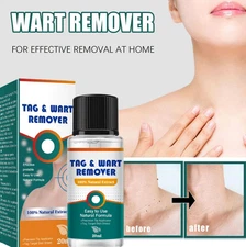 Wart Mole Vanish Body Care - 20ml - All-in-One Mole, Wart & Skin Tag Remover
