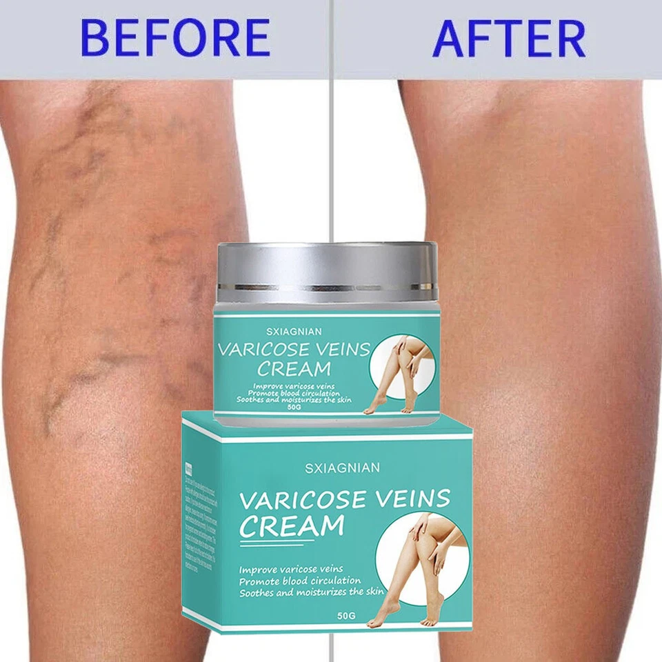 SXIAGNIAN Varicose Veins Treatment Cream Vasculitis Phlebitis Spider Relief Pain Ointment~