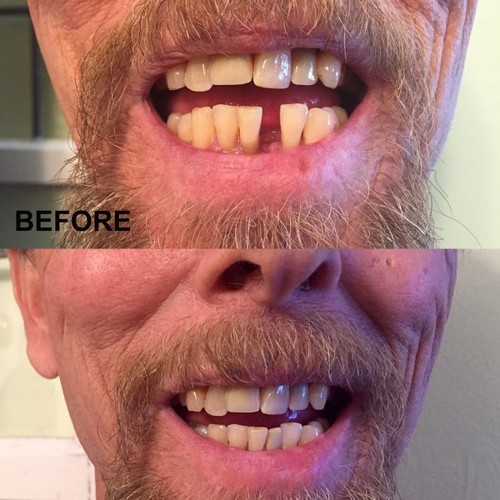 KIT DE REEMPLAZO DE DIENTES INSTANTÁNEO SMILE SELECT reparación temporal de dientes perdidos NATURAL - Imagen 6 de 6