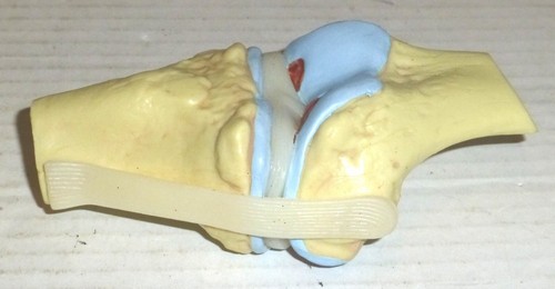 Set of 2 GPI Anatomicals Stages of Osteoarthritis Knee Joint Models (2004) READ - Picture 6 of 10