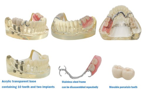 Dental Implant Modle,Demo RPD/ Overdenture/All-On-4 Treatment Restoration Type - Picture 123 of 164