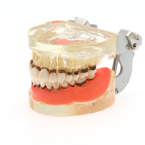 Dental Adult Periodontal Disease Pathological Teeth Model Removable Gum M4017 - Picture 16 of 17