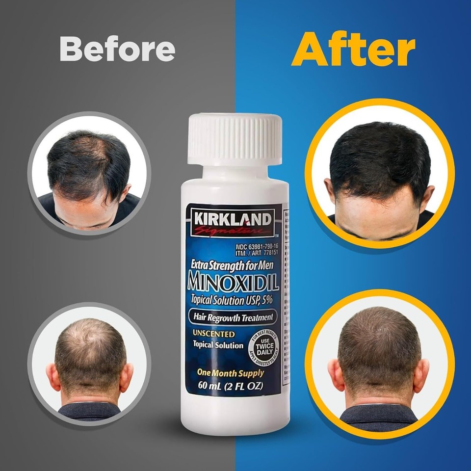 Kirkland Minoxidil 5 Hair Regrowth Treatment AUTHENTIC 100 Exp 11/