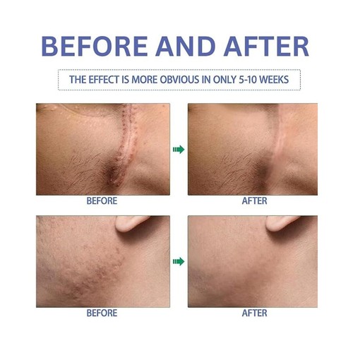 Silikon Narbengel, fortschrittliches Narbengel für chirurgische Narben, Kaiserschnitt, Dehnungsstreifen - Bild 4 von 7