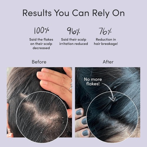 Soothing Anti-Dandruff Shampoo and Conditioner for Itchy, Flaky Scalp Relief - Picture 4 of 10