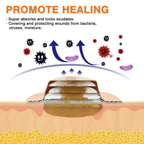 Silicone Sacrum Foam Dressing, 9''x9''(23cm x23cm) Bordered Silicone Adhesive... - Picture 5 of 6