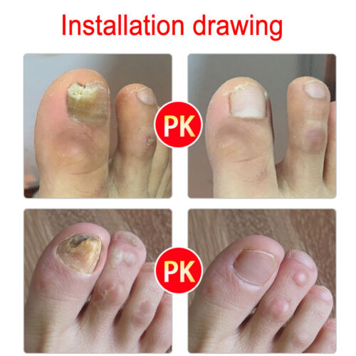 1x Essence Oil Nail Fungus Killer Toe Fungus Treatment Onychomycosis Removal - Picture 6 of 12