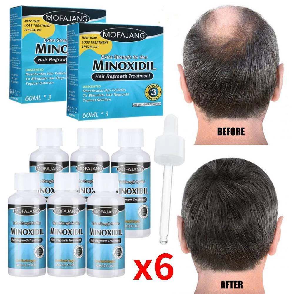 6PCS Extras Strength Men Hair Regrowth Treatment Regain Anti hair Loss Lotion