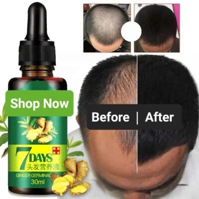 7 Days Herbal Hair Growth Ginger Germinal Oil Hair Regrowth Nutrient UK SELLER