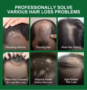 Lidoria Hair Growth Serum 7 Days Fast Regrowth Anti-Hair Loss Scalp Repair - Picture 1 of 8