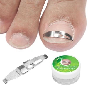 Nail Recover Correction Ingrown Toenail Straightener Paronychia Pedicure Tools - Picture 1 of 5