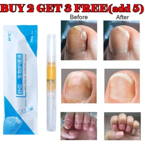 Anti Fungal Nail Treatment Finger Toe Fungus Repair Care Treatment Liquid Pen - Picture 1 of 12