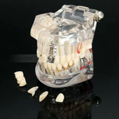 LEADTECH Removable Dental Implant Disease Teaching Teeth Model & Restoration Bridge Tooth
