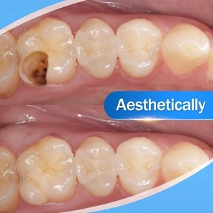 Denti Cemento Dentale Resina Denti Riparazione Gap Cavità Riempimento Denti Forte Riparazione - Foto 1 di 10