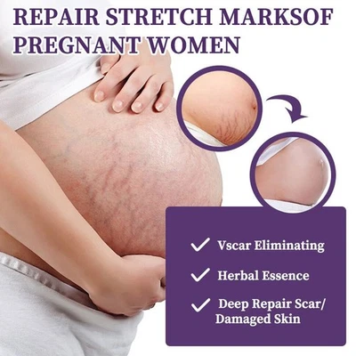 30ML Scar Gel Cream Stretch Marks Removal Cream Surgery Scar Skin Care - Image 1 of 4