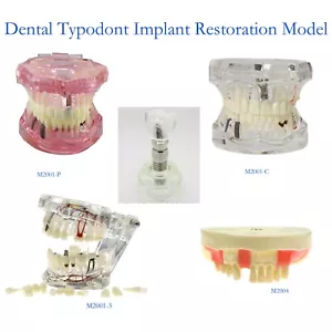 Modelo de implante y restauración de tipodonte dental modelo de demostración práctica de dientes modelo de tipodonte - Imagen 1 de 61