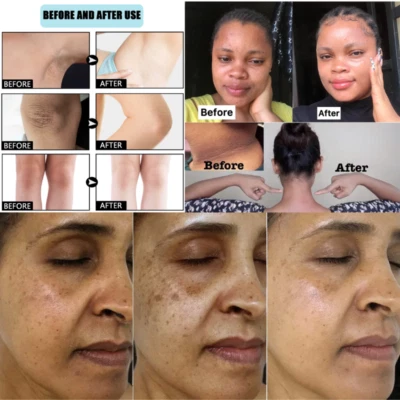 KOZICARE Best Dark Spot Whitening Lightening Glowing Skin Cream Face Intimate Parts 15gm