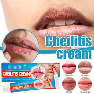 20g Cheilitis Cream Inflammation Labial Chapped Lips Antibacterial Ointments - Picture 1 of 14
