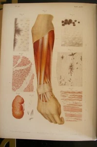 ATLAS DE ANATOMIA PATOLOGICA 1874 ANATOMY PATHOLOGY  2 vols Text  & Atlas - Picture 1 of 12