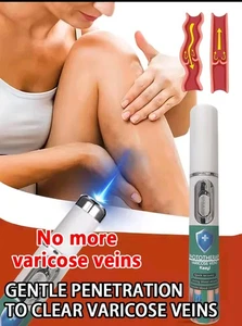 Varicose veins Removal Treatment not Cream Very Effective - Picture 1 of 7