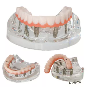 Implante dental todo en 6 sobredentadura modelo demostración mandíbula superior 6 tornillos transparente M6001-2 - Imagen 1 de 11