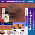 Painless Wart Remover Pen Eliminate Skin Tag Foot Corn Mole Warts Restoration US
