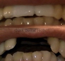 Provisorischer Zahnersatz  Quick Dental Tooth Zähne Zahnfüllung 🆘