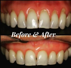 Extra Strength Super Potent Gum Disease Cure Stop Bleeding Receding Gums Teeth