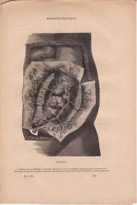 Alte medizinische Gravur 108 - Praktische & Volksmedizin - Perilyphlitis - Bild 1 von 1