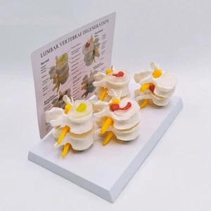 Sick Human Lumbar Model Vertebrae Degenerative Disc Disease Anatomical Model - Picture 1 of 5