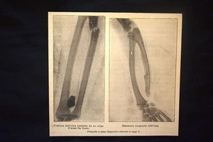 Raggi X: Frattura ulna prodotta da arma da fuoco - Mancanza congenita dell'ulna - Picture 1 of 1