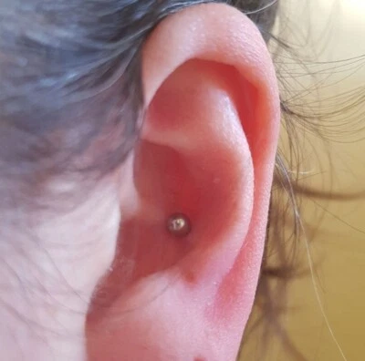 Perno caracola bola esterilizado de 5 mm con pernos de acero quirúrgico de 6, 8 y 10 mm. Foto 1 de 4