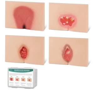 Modelo de cuidado de heridas por úlcera de decúbito, modelo de úlceras decúbito, modelo de lesiones por presión - Imagen 1 de 6