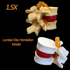 1.5X Anatomical Spine Lumbar Disc Herniation Anatomy Medical Teaching Tool Model