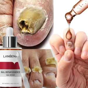 Nail Repair Serum Fungal Nail Treatment Liquid Remove Toe Nail Fungus Essence - Picture 1 of 20