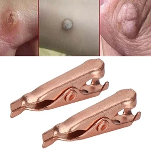 Small Skin Tag Remove Chip Pure Copper Tag Clips Body Wart Tag Extractor For FSK - Bild 1 von 22