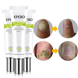 EFERO Nail Anti Fungal Infection Gel Treatment Hand Foot Cream Toenails RemovalF