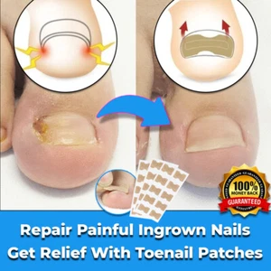 NEW SAFE INGROWN TOENAIL CORRECTION PATCH NAIL REPAIR STRAIGHTENING TOOL STICKER - Picture 1 of 3