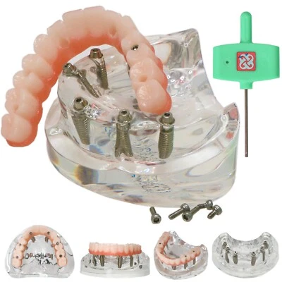 Implante Dental EE. UU. Modelo de Sobredentadura Todo en 6 Tratamiento Mandíbula Superior 6 Tornillos, Transparente Foto 1 de 4